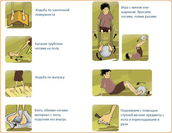 Способы лечения плоскостопия у детей - 3 легких способа