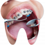 Исправление кривизны зубов ортодонтическими скобами (брекетами)