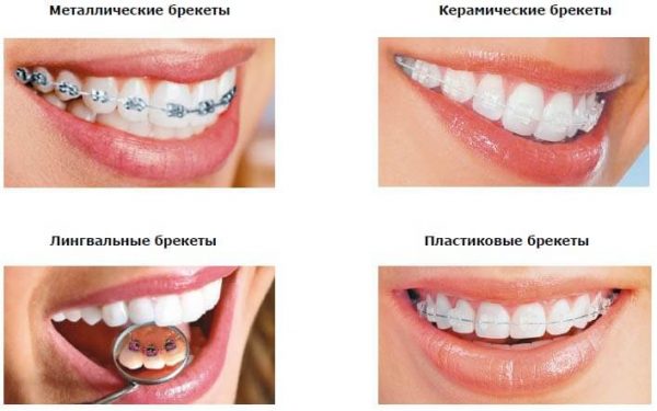 Исправление кривизны зубов ортодонтическими скобами (брекетами)