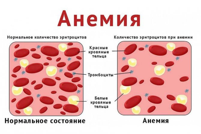 Что такое анемия