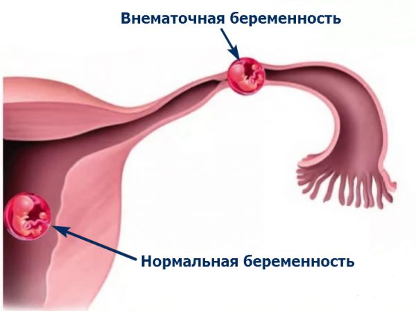 Внематочная беременность: причины и сможет ли женщина еще выносить ребенка