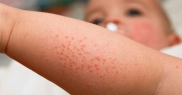 Аллергия на солнечные лучи у детей: причины, симптомы, лечение