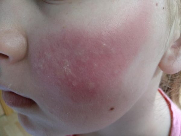 Аллергия на солнечные лучи у детей: причины, симптомы, лечение