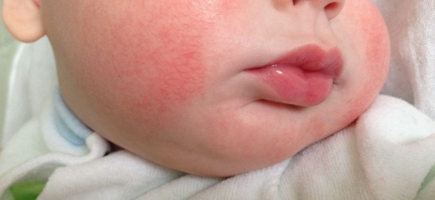 Аллергия у новорожденных