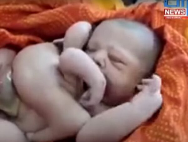 Божество или аномалия: в Индии родился ребенок с четырьмя руками и ногами
