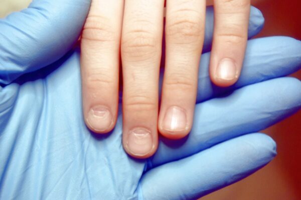 Обращаем внимание: ломкие ногти у детей. Причины, лечение
