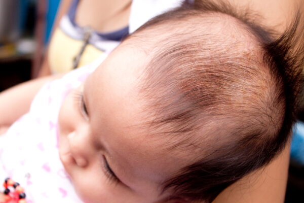 Образование желтоватых корочек на части головы, покрытой волосами - причины, как лечить