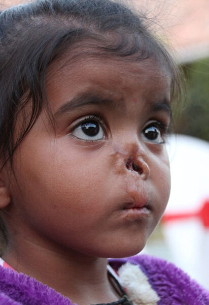 Учительница удочерила побитую жизнью девочку с серьезными дефектами на лице - как она выглядит после вмешательства хирургов