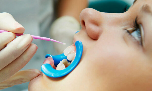 Продукты, разрушающие детскую зубную эмаль, и что нужно употреблять в пищу для красивых и здоровых зубов