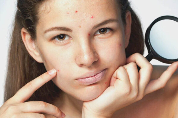 Особенности ухода за кожей в подростковом возрасте: полезные советы от экспертов
